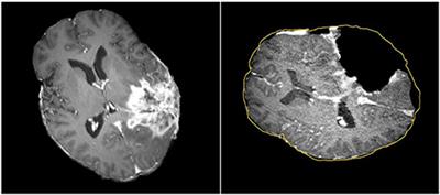 Adaptive Physics-Based Non-Rigid Registration for Immersive Image-Guided Neuronavigation Systems